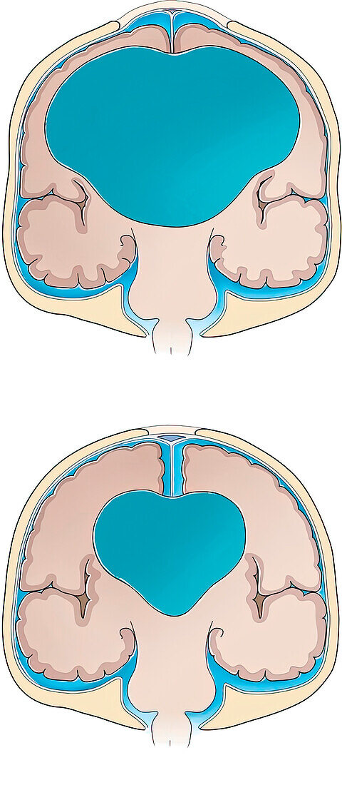 Severe hydrocephalus, illustration