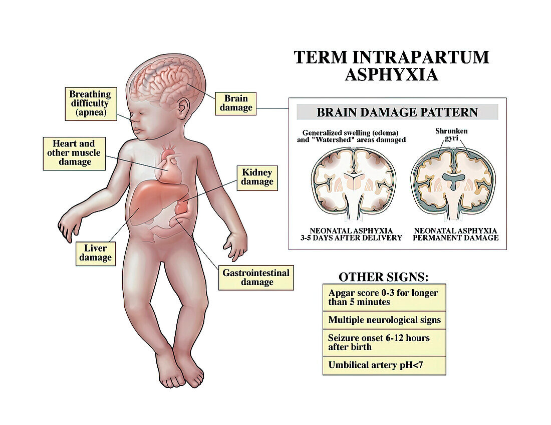 Term intrapartum asphyxia and brain damage, illustration