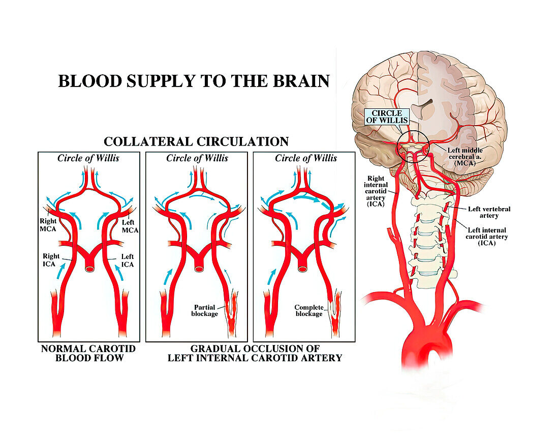 Gradual occlusion of left internal carotid artery, illustration