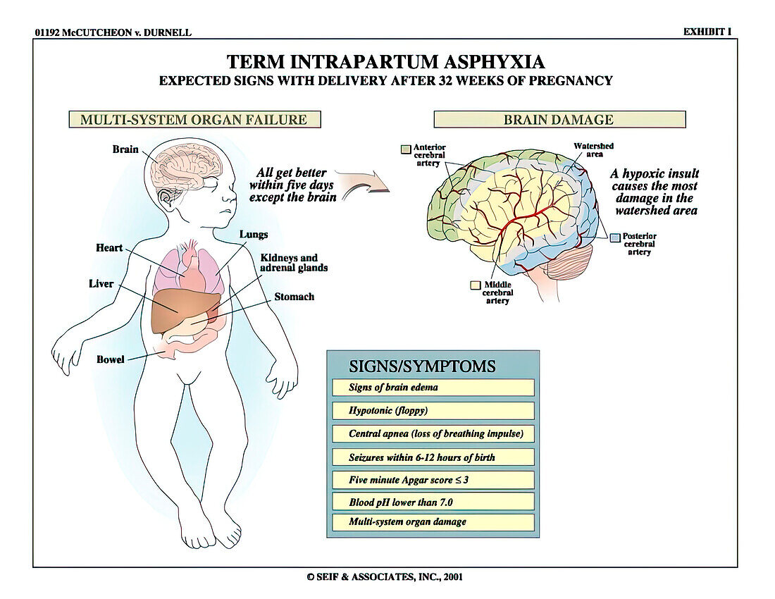Signs of term intrapartum asphyxia, illustration