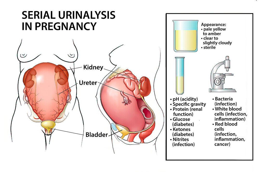 Serial urinalysis in pregnancy, illustration