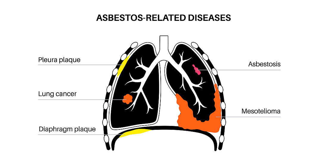 Asbestos related diseases, illustration