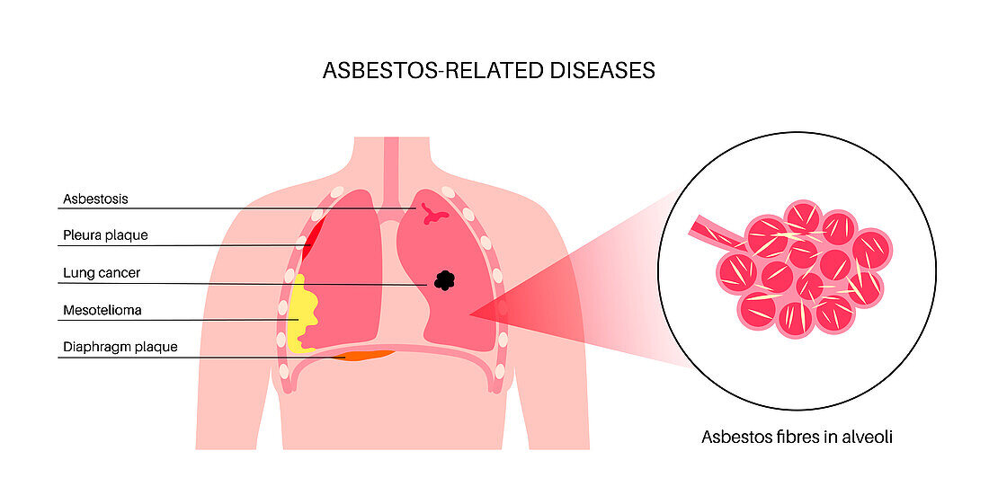 Asbestos related diseases, illustration