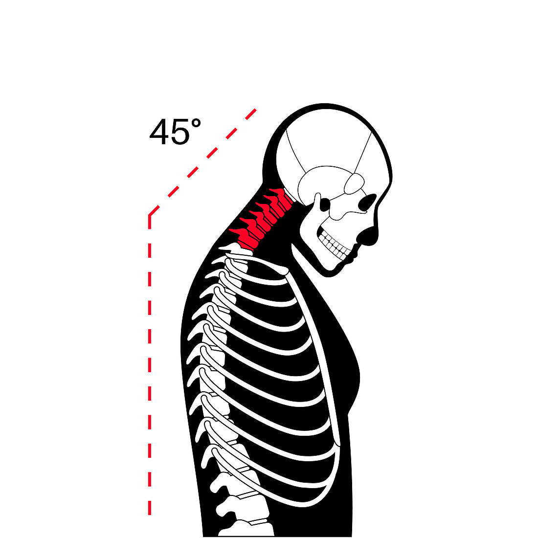 Neck vertebrae deformity, illustration