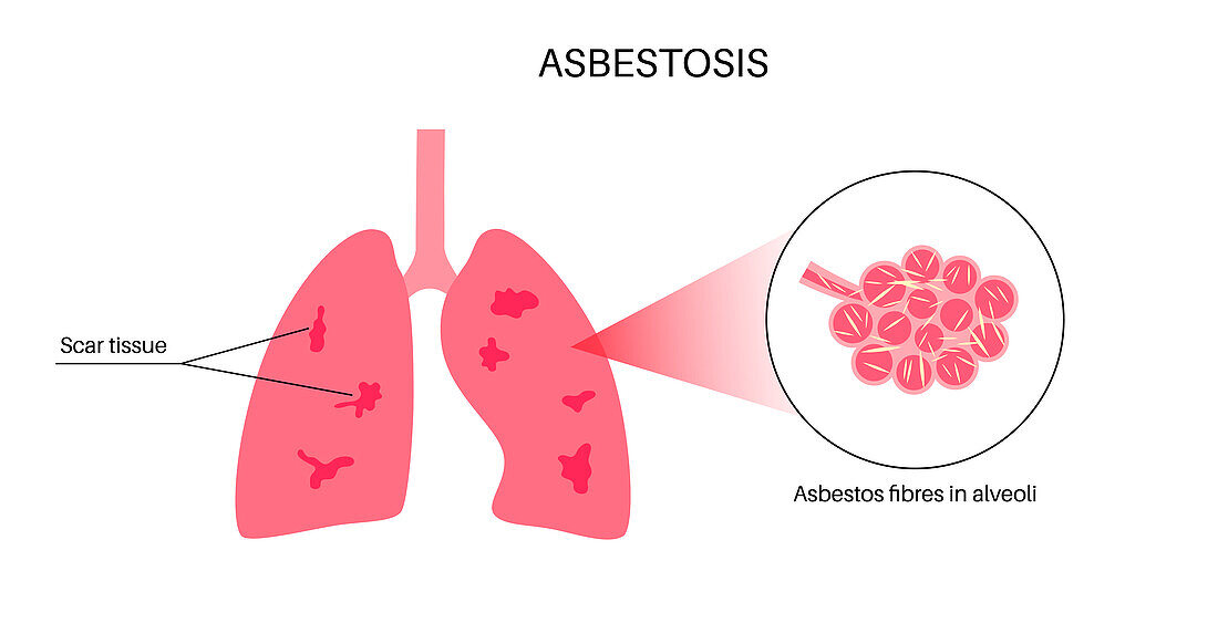 Asbestosis lung disease, illustration