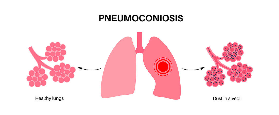 Pneumoconiosis lung disease, illustration