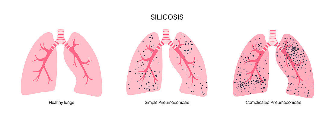 Silicosis dust in lung, illustration