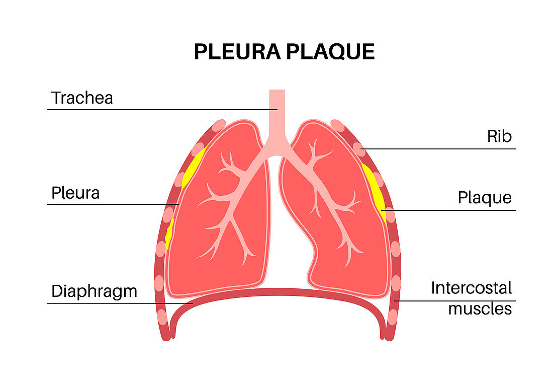 Pleural plaque, illustration