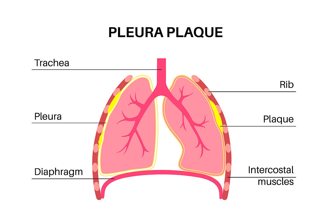 Pleural plaque, illustration