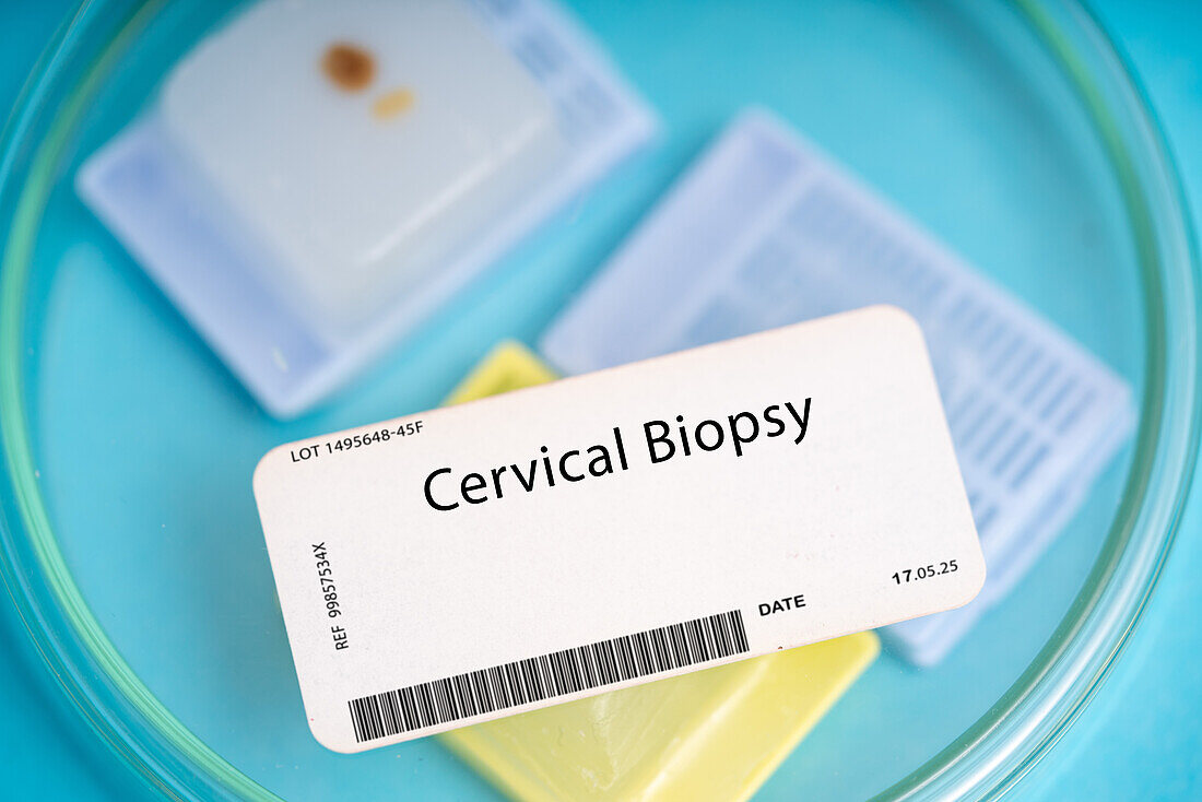 Cervical biopsy