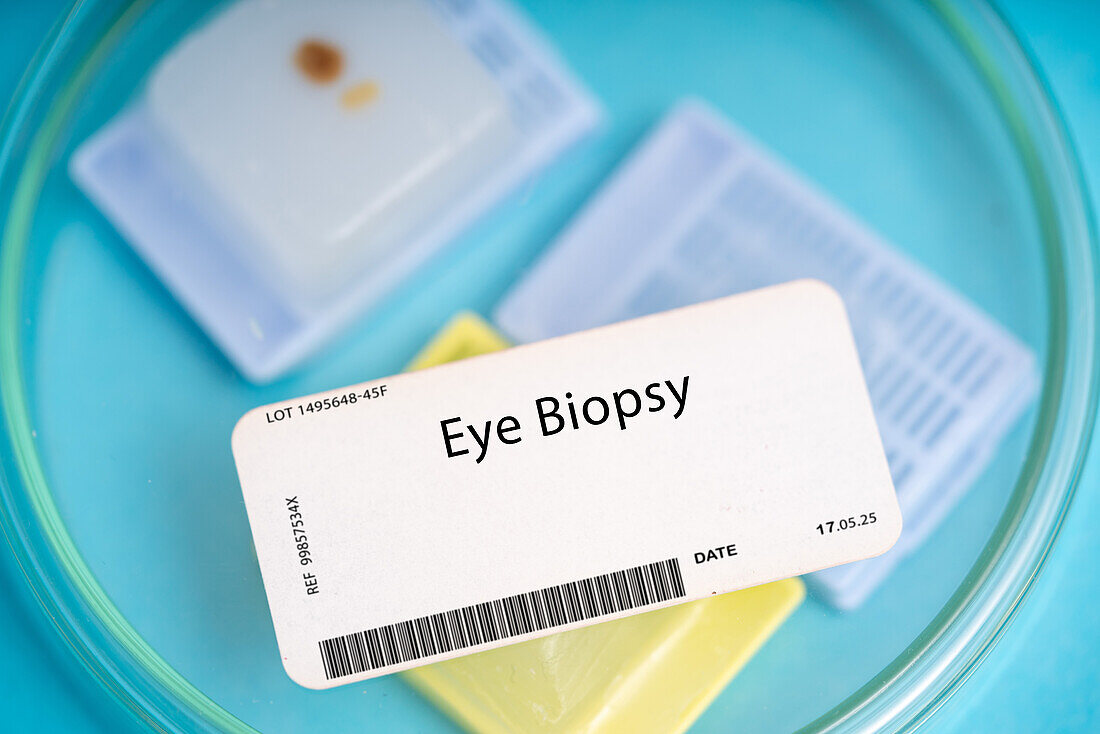 Eye biopsy