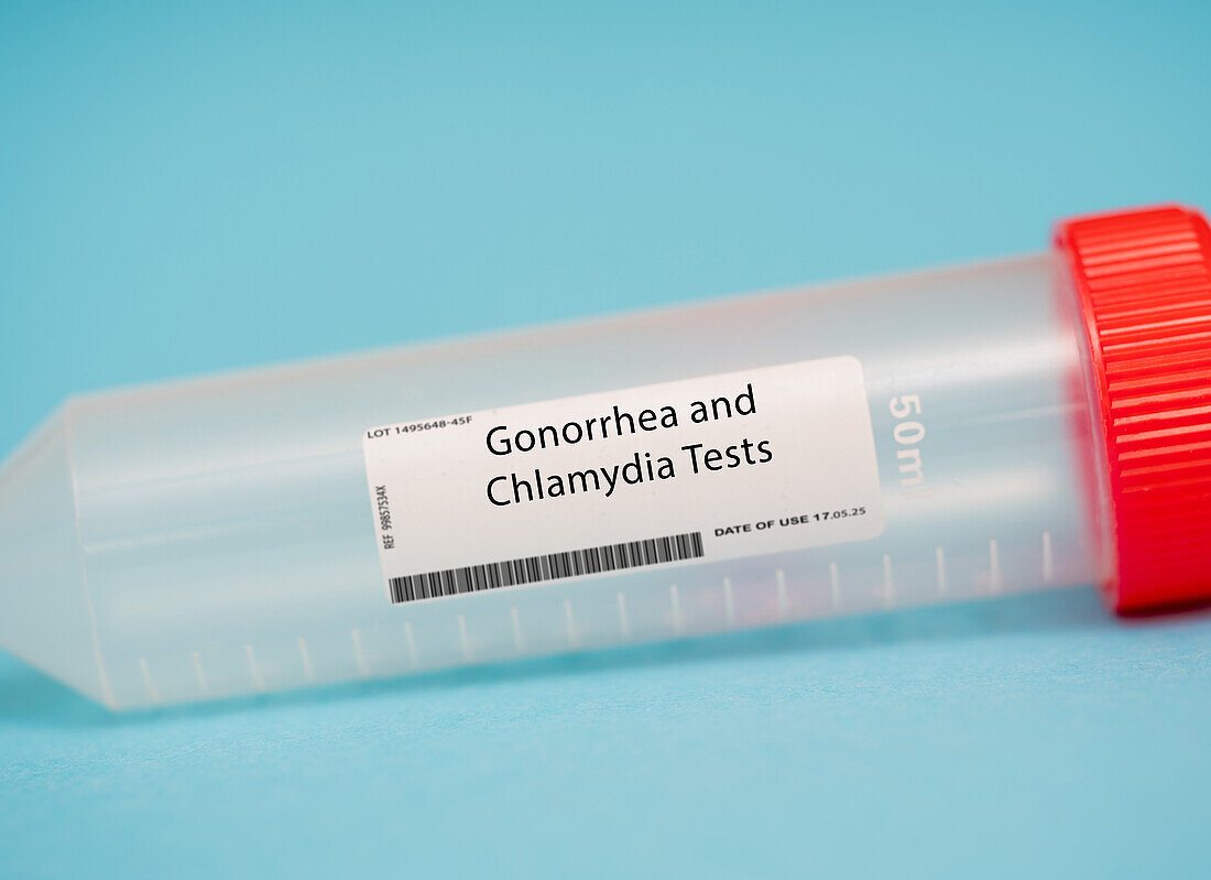 Gonorrhoea and chlamydia tests