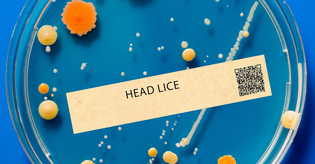 Head lice parasitic infection
