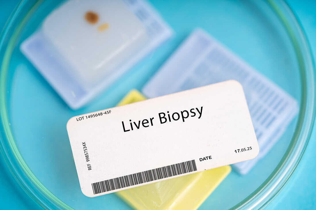 Liver biopsy