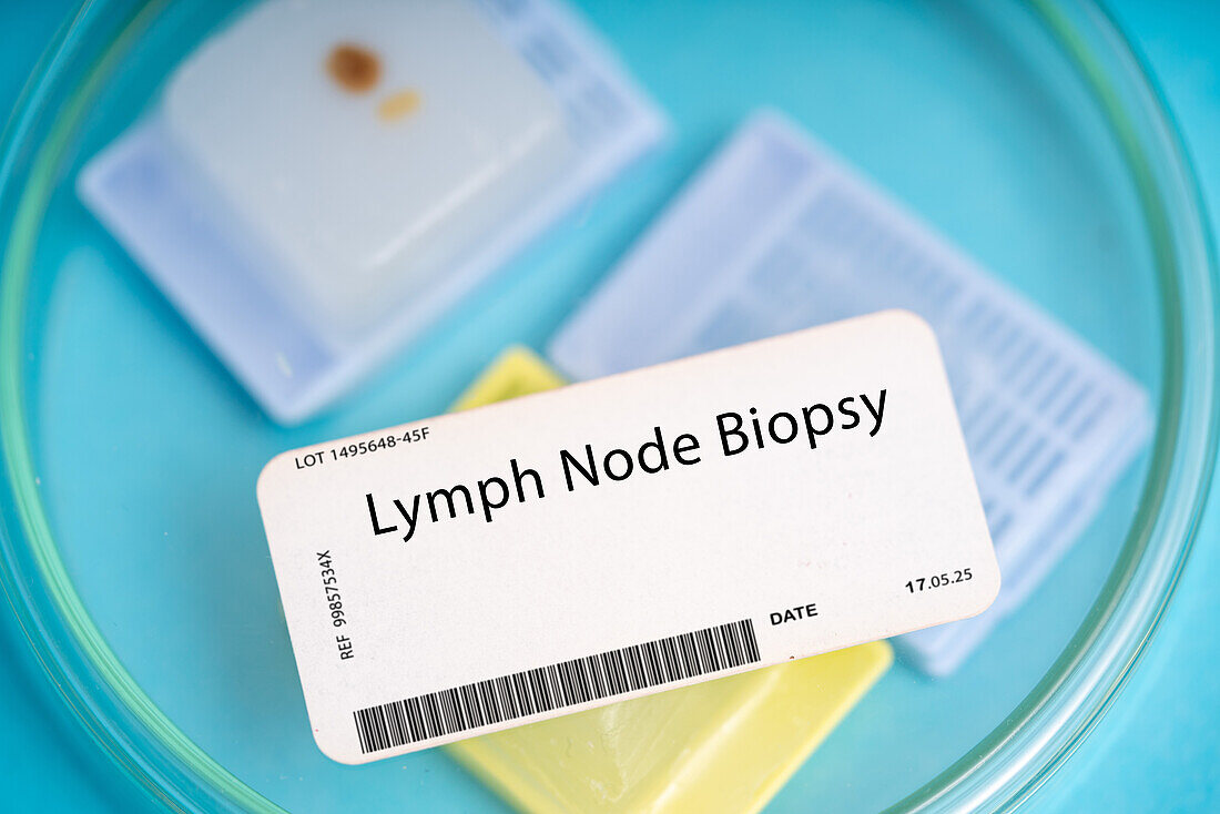 Lymph node biopsy