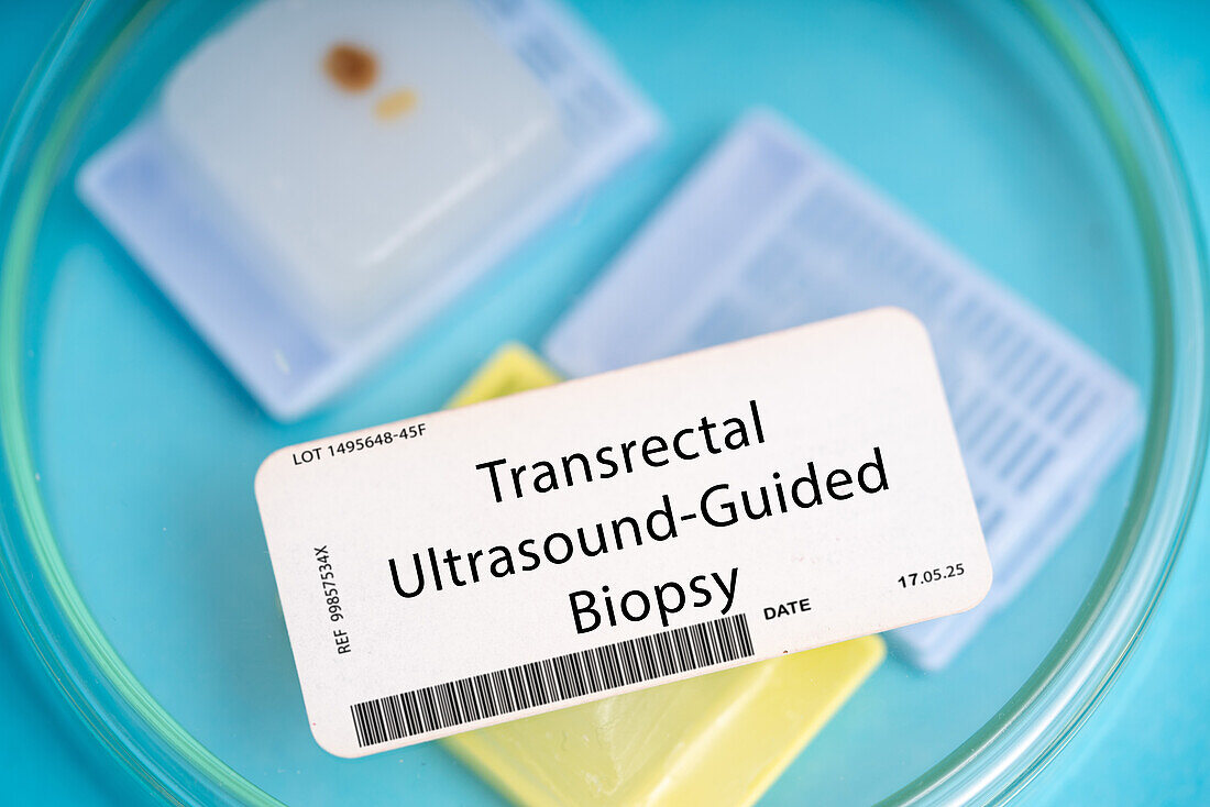 Transrectal ultrasound-guided biopsy