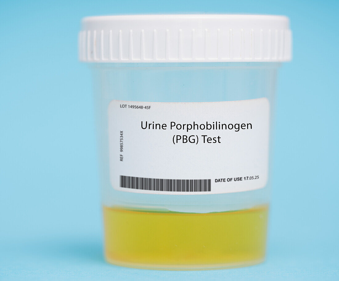 Urine porphobilinogen test