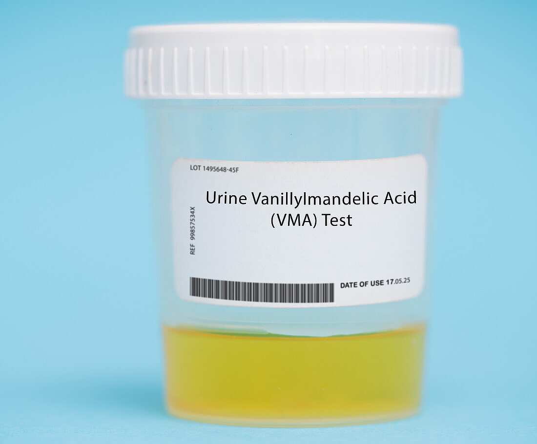 Urine vanillylmandelic acid test