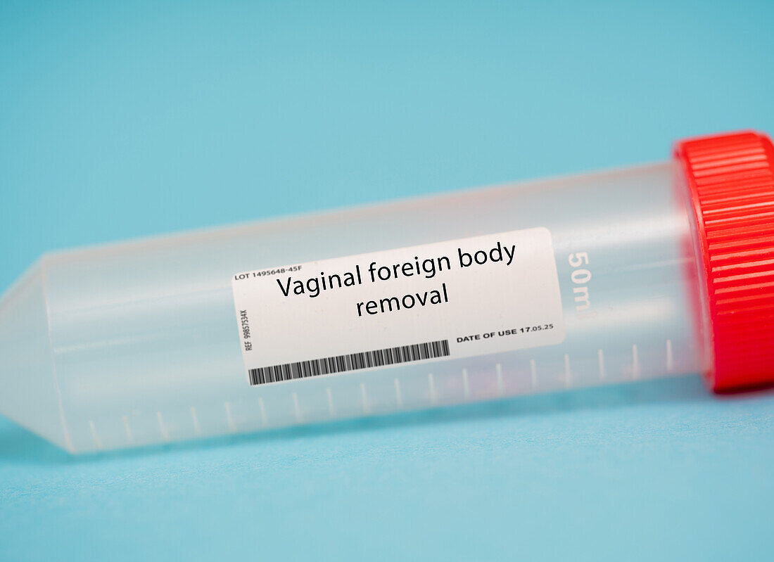 Vaginal foreign body removal