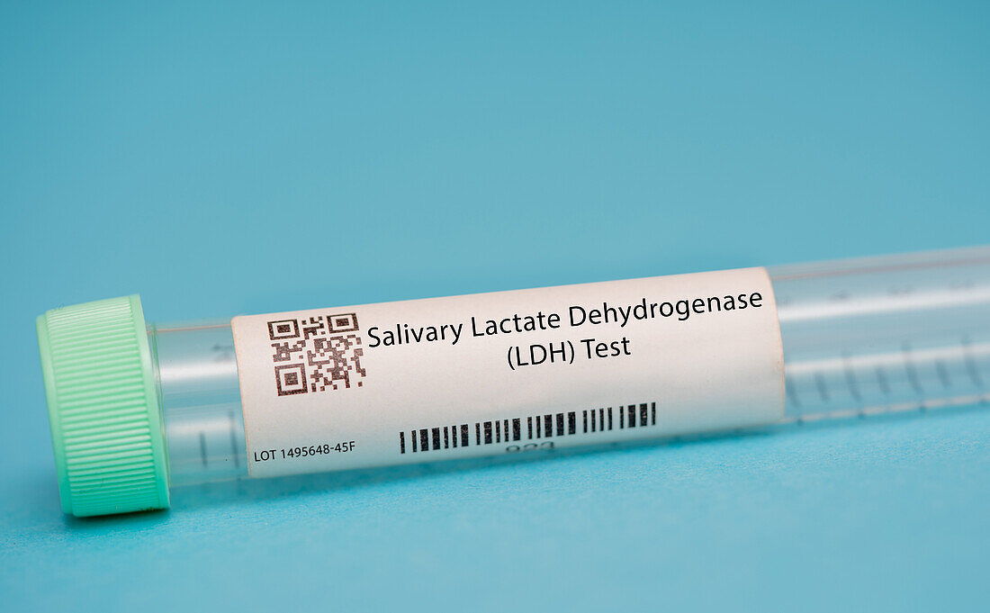 Salivary lactate dehydrogenase test
