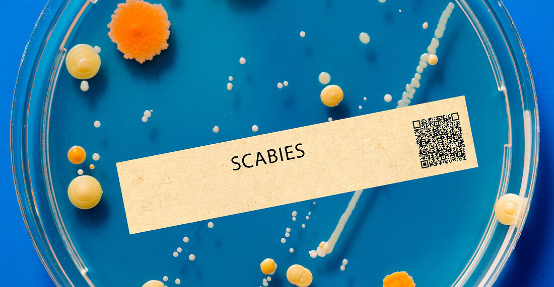 Scabies parasitic infection
