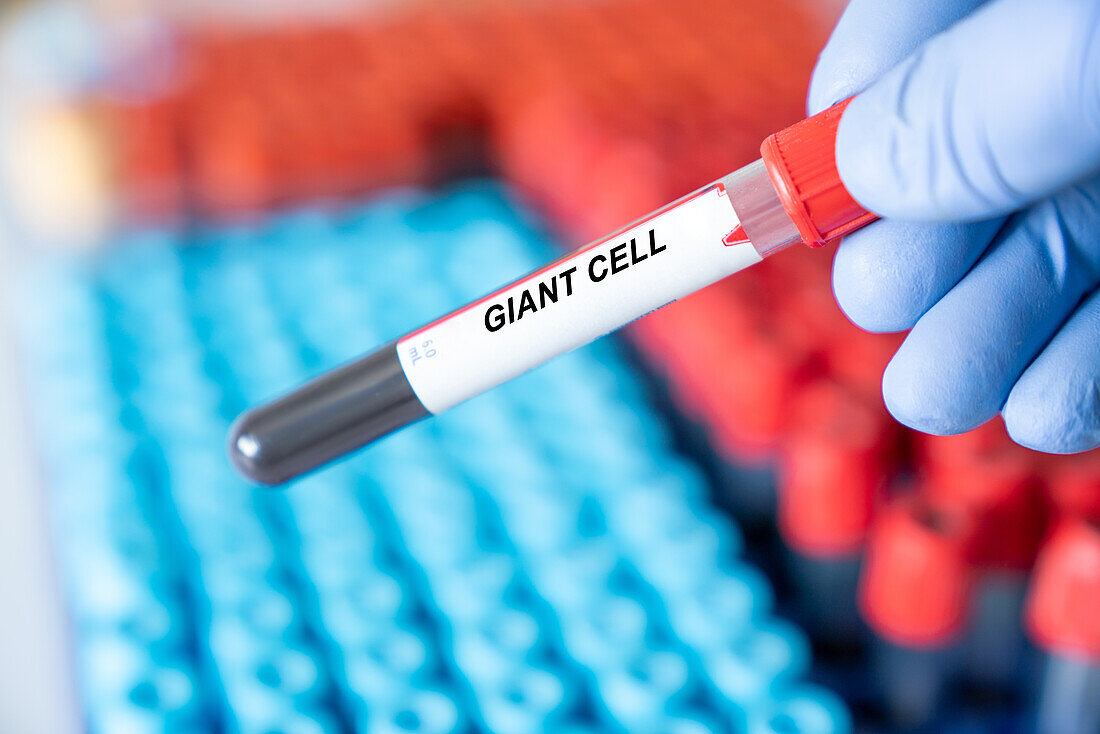Giant cell blood test