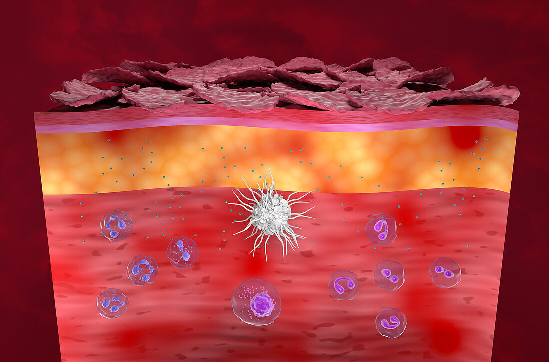 Atopic dermatitis, illustration