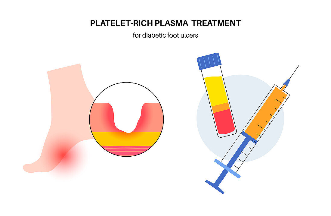 Diabetic foot syndrome treatment, illustration