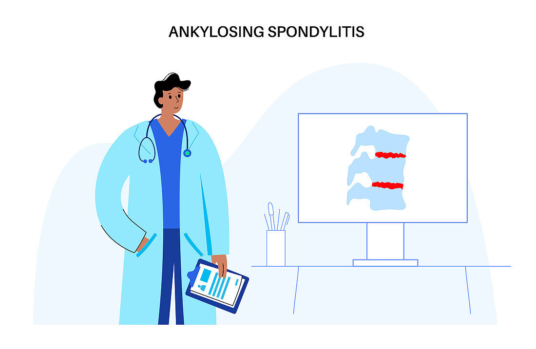 Ankylosing spondylitis, illustration
