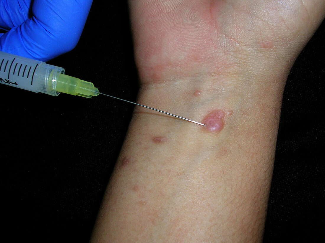 Intralesional injection for lichen planus