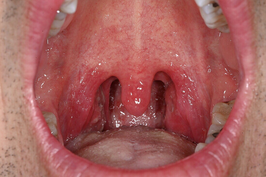 Acute tonsillitis in woman's throat