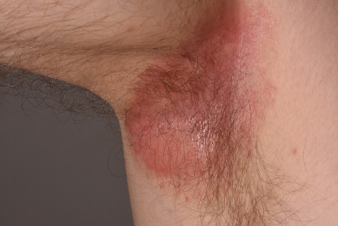 Psoriasiform eczema on a man's armpit