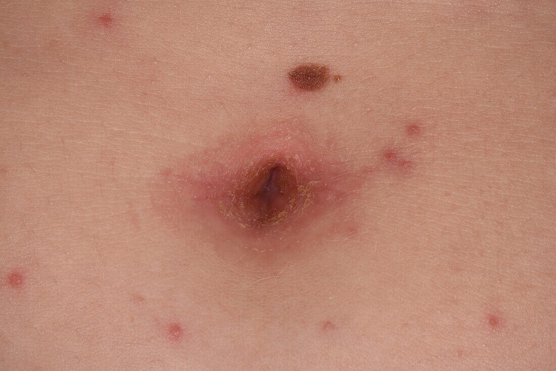 Eczema on a woman's navel