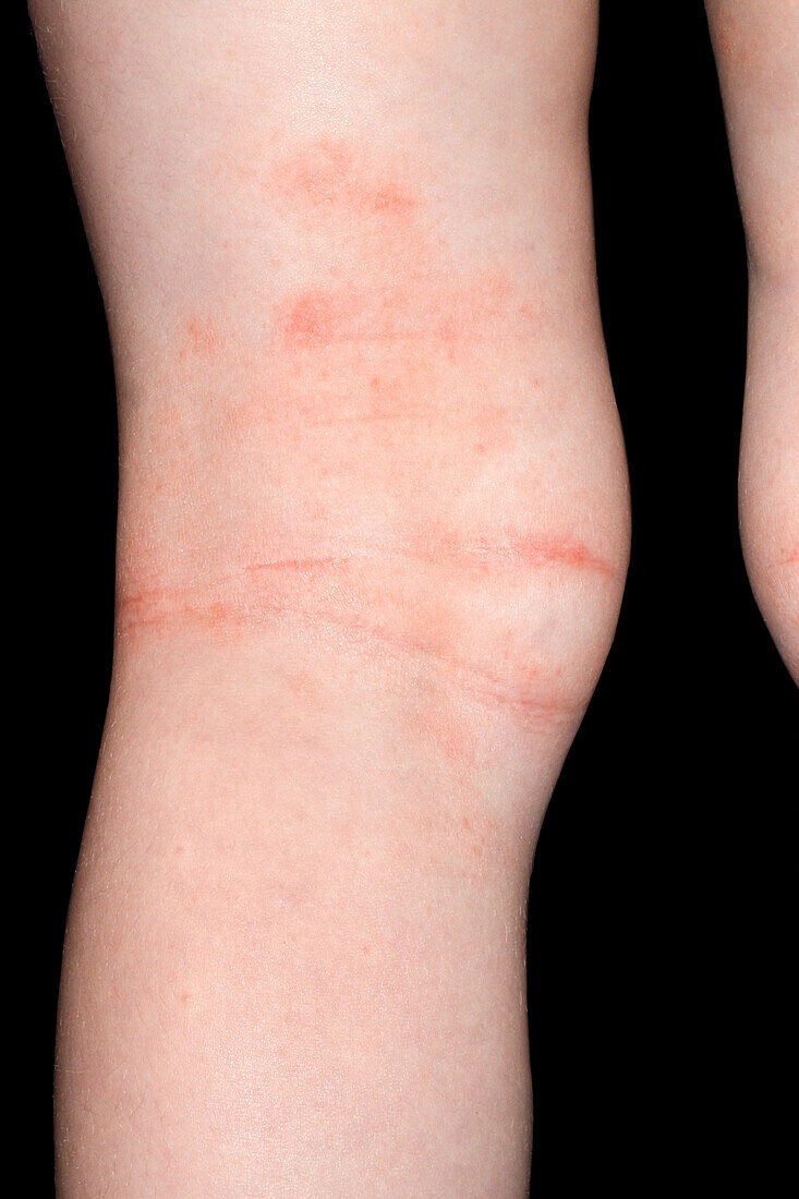 Eczema on a girl's inner elbow