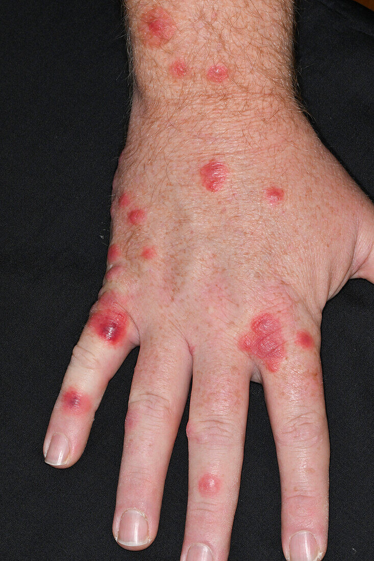 Reaction to insect bites on a woman's hand