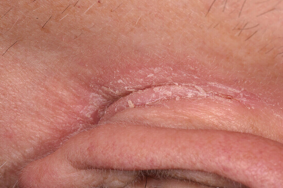 Eczema behind a man's ear
