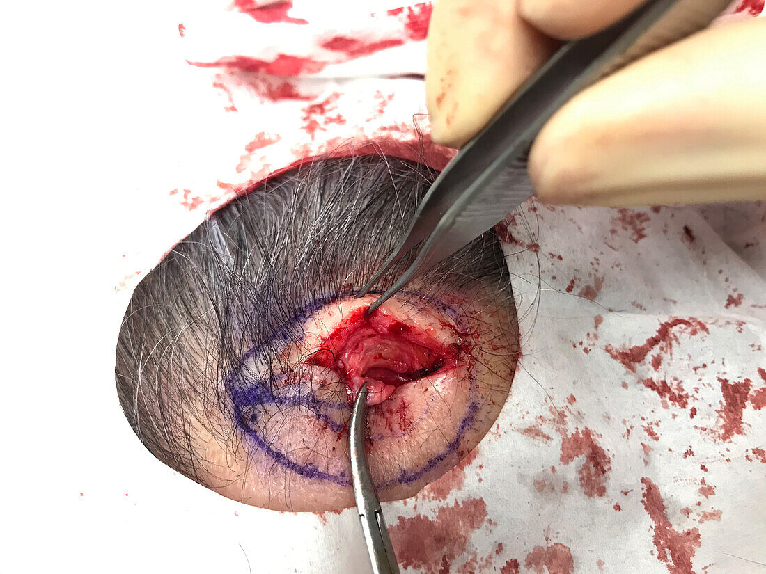 Fibroma removal