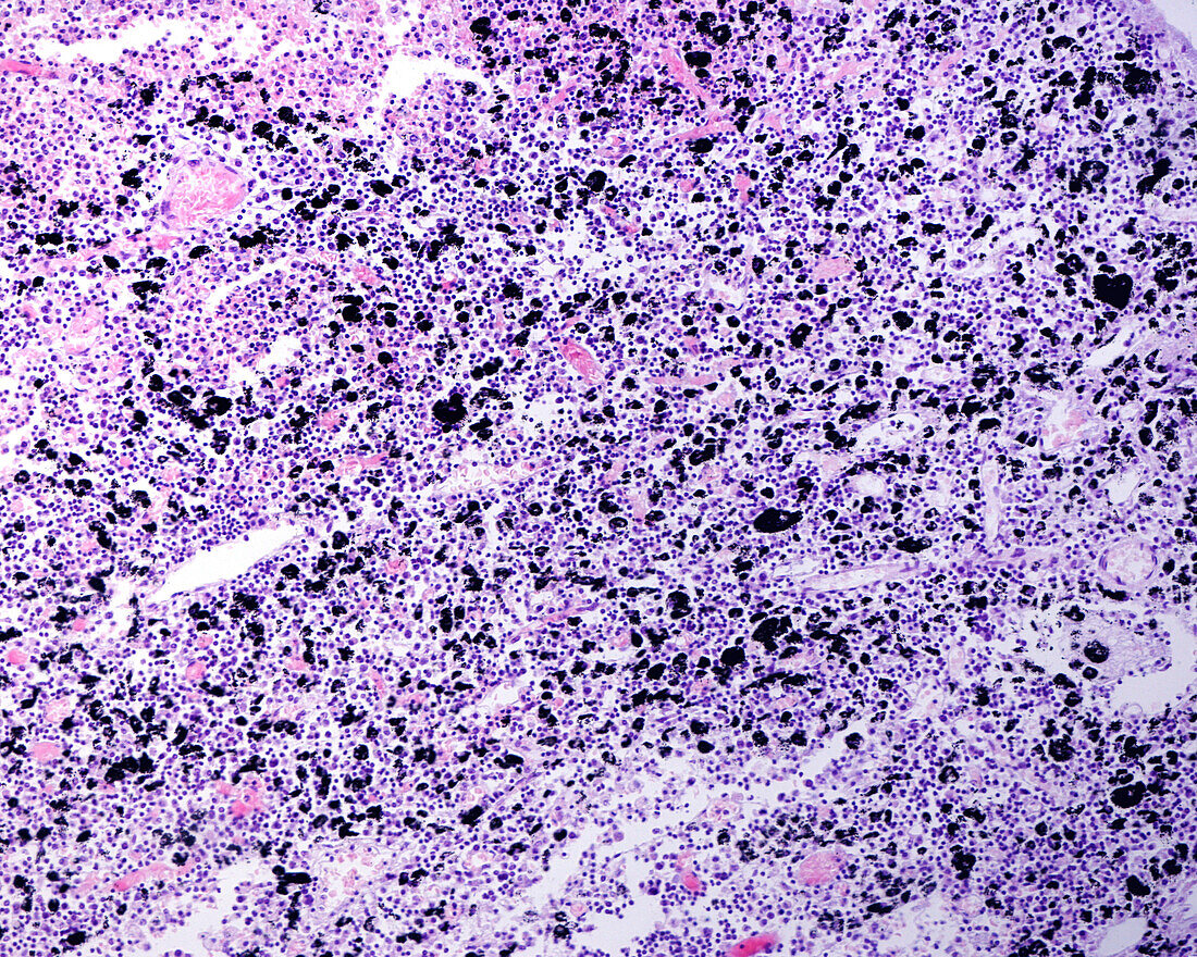 Lymph node anthracosis, light micrograph