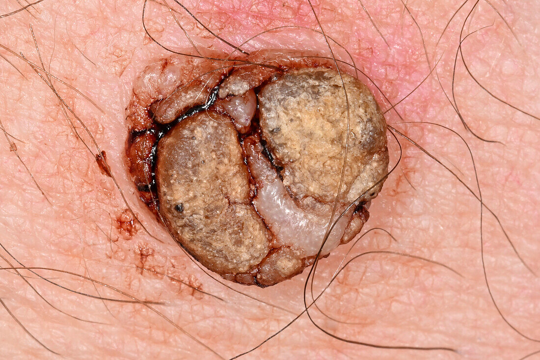 Seborrhoeic keratosis in a male patient