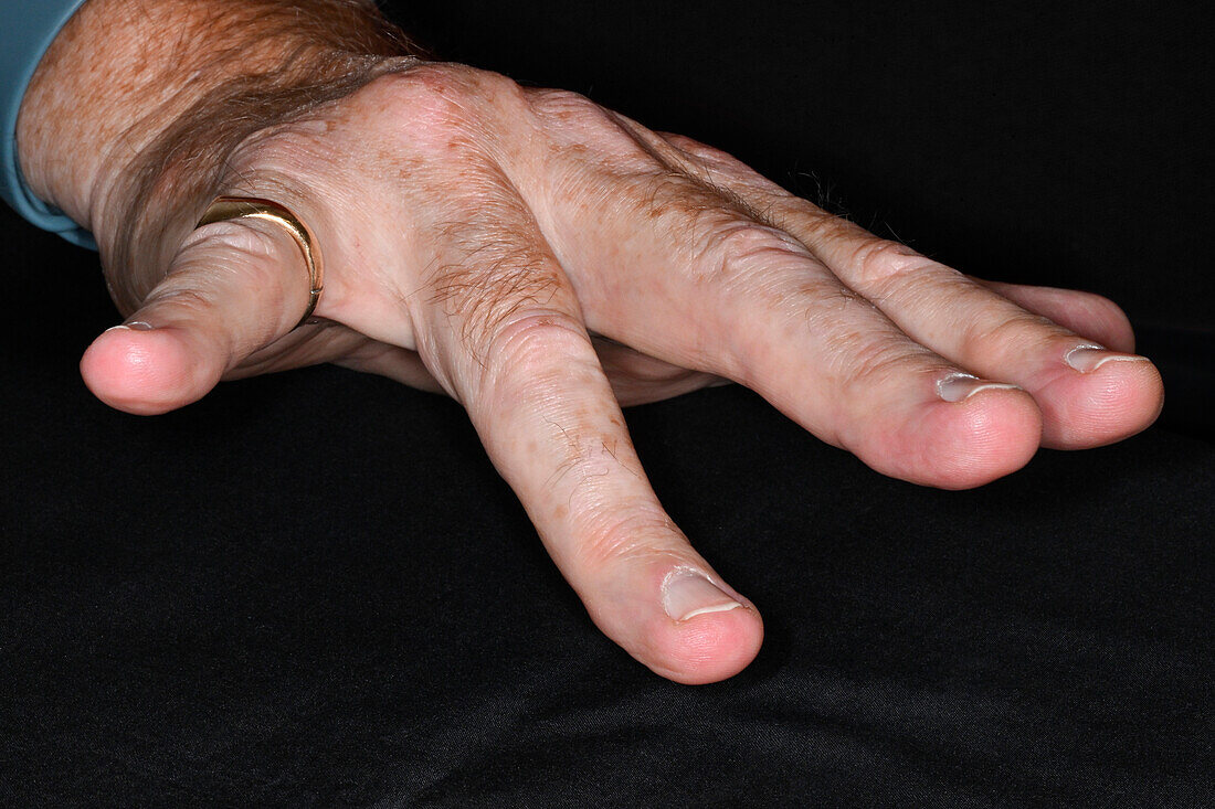 Dupuytren's contracture in a man's hand