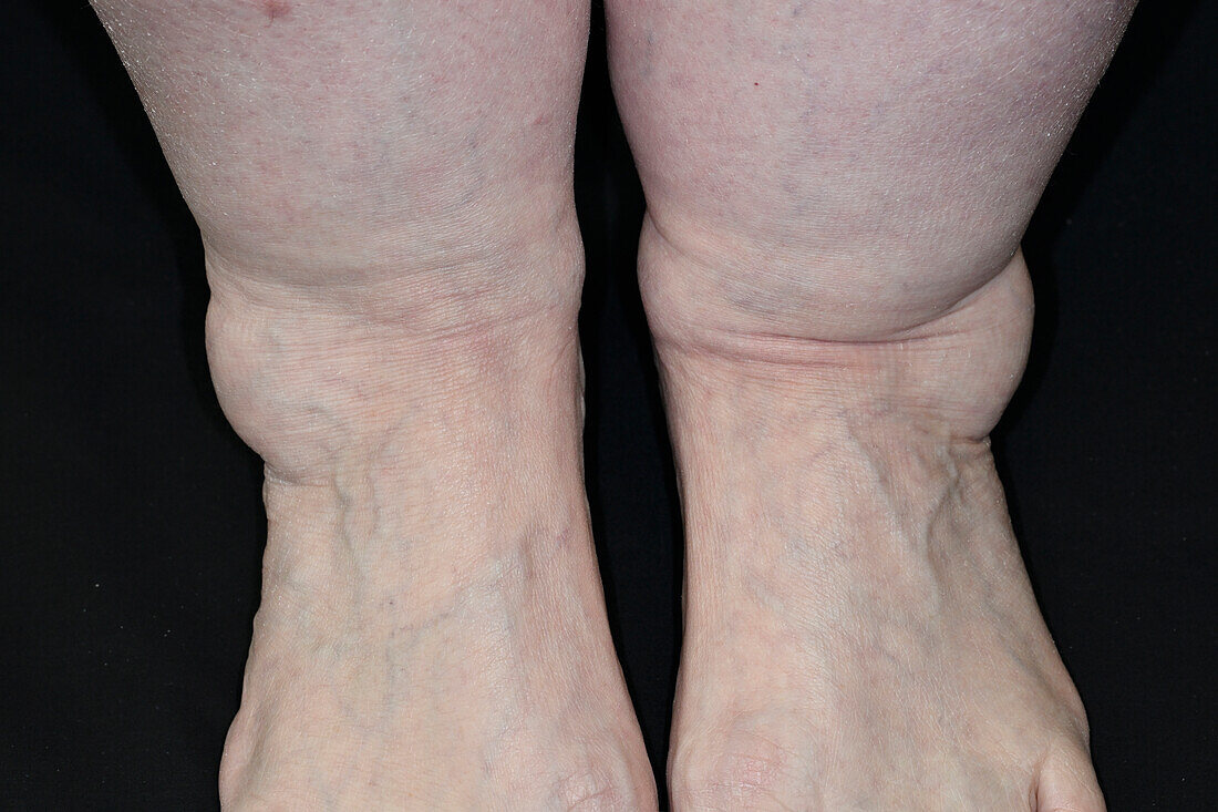 Ganglion cyst on a woman's ankles
