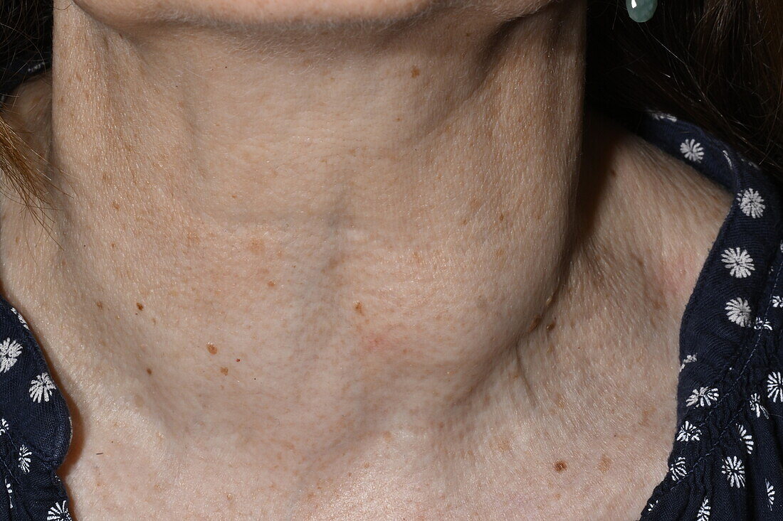 Multinodular goitre of thyroid in female patient