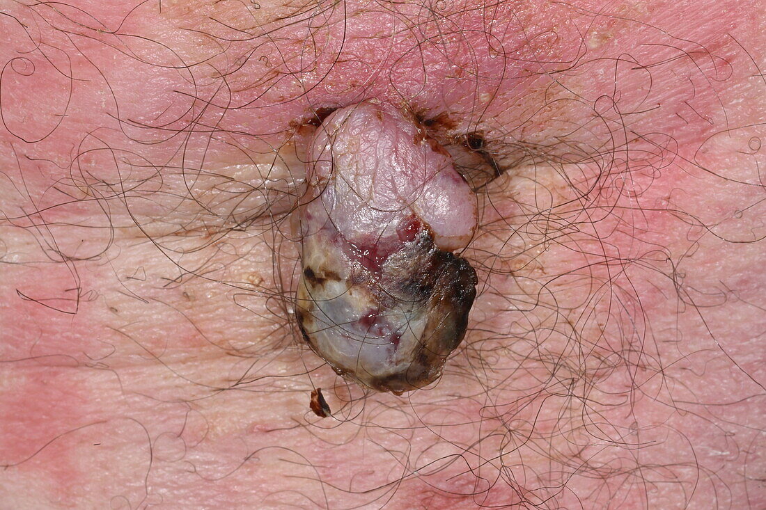 Thrombosed hemangioma on a man's back
