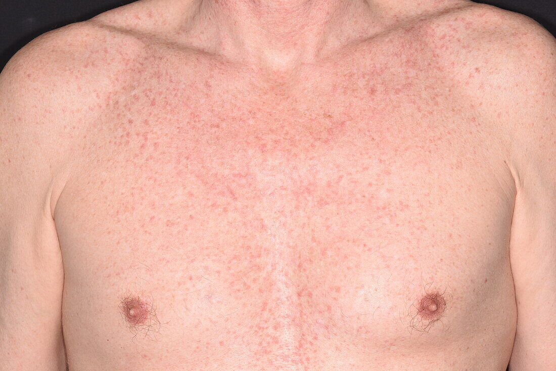Grover disease on a man's chest