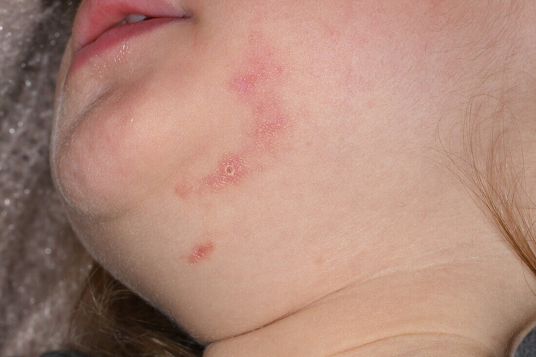 Cutaneous larva migrans infection on a girl's chin