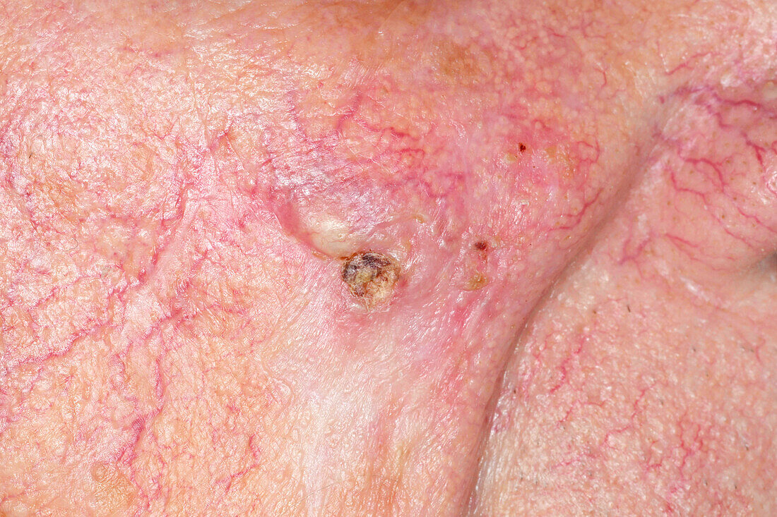 Basal cell carcinoma on a man's cheek