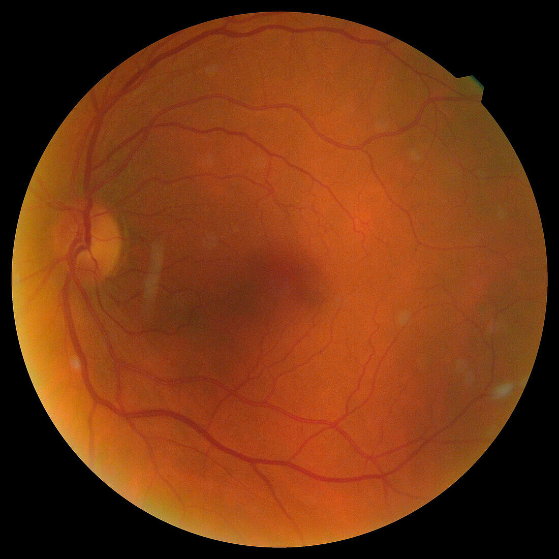 Healthy eye, funduscopy scan