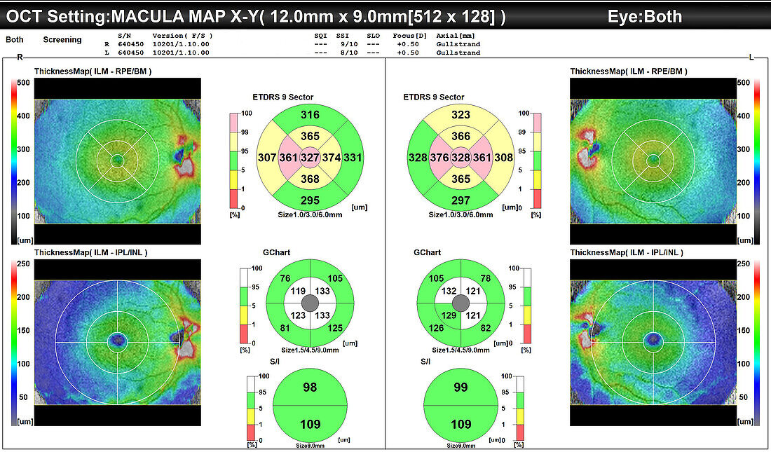 Retinal thickness maps of healthy eyes, OCT scan