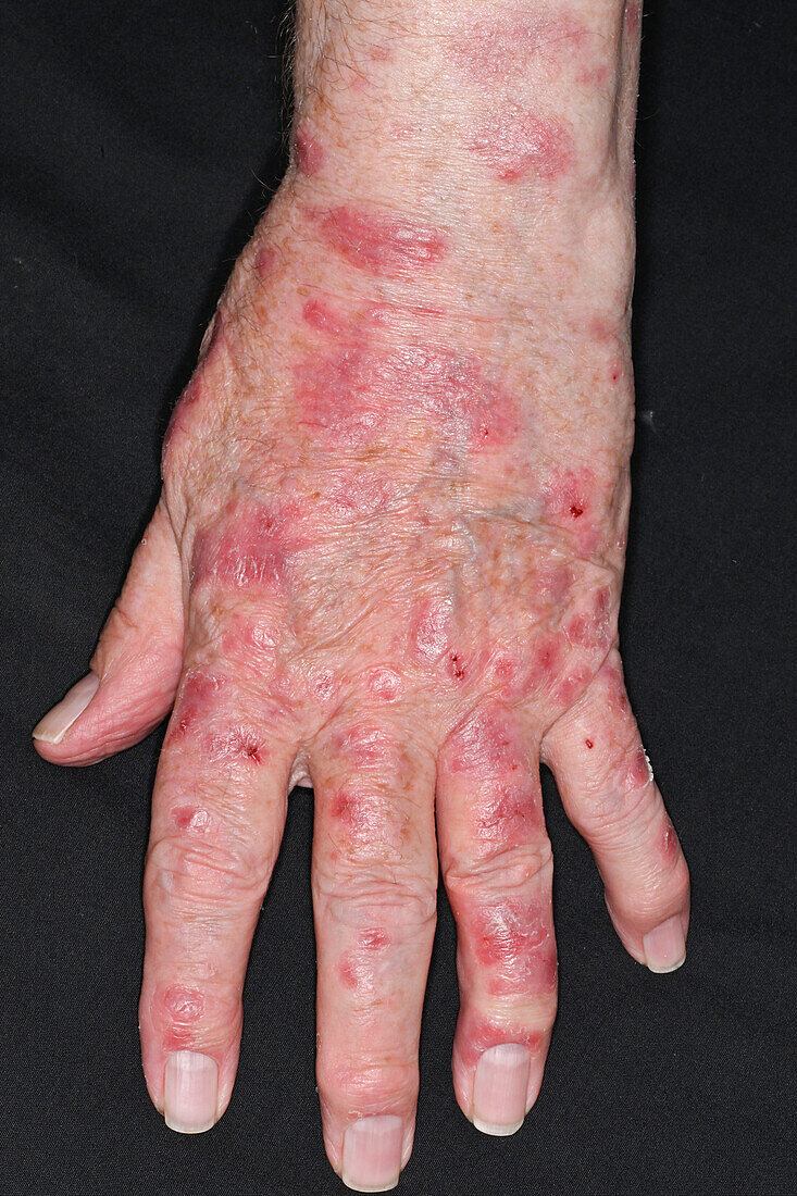 Psoriasis on a man's hand