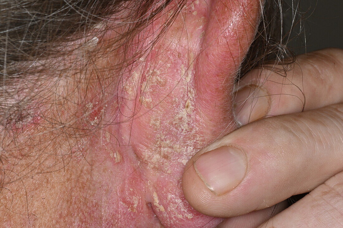 Psoriasis behind a man's ear